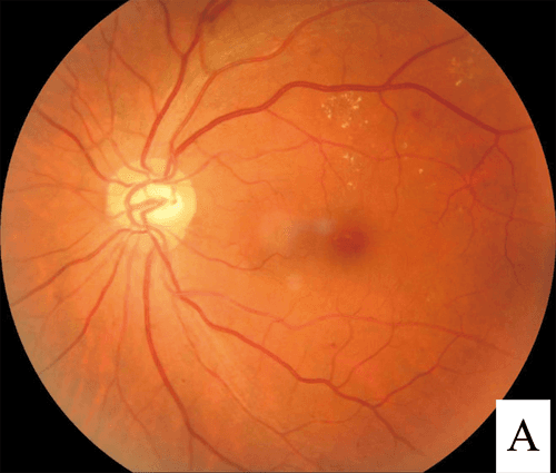 Fundus photograph showing signs of diabetic retinopathy in the eye
