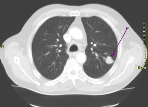 CT scan of the thorax showing a peripheral bronchial carcinoma